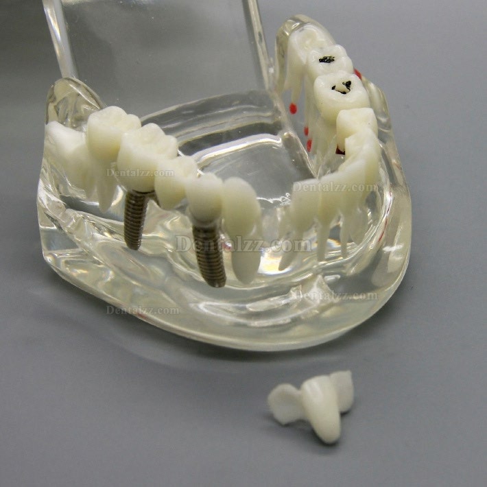 歯科インプラント研究分析用モデル 歯科疾患と回復モデル